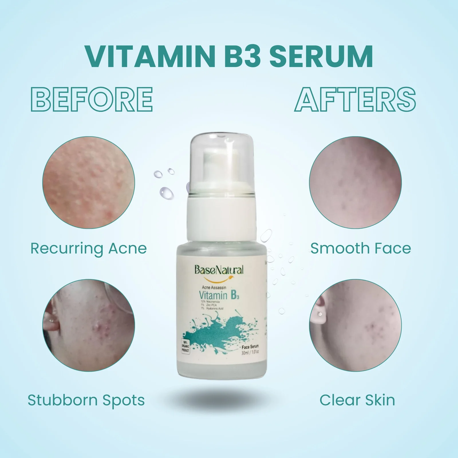 Best Acne Assassin Serum in Pakistan (2) Best Acne Assassin Serum in Pakistan