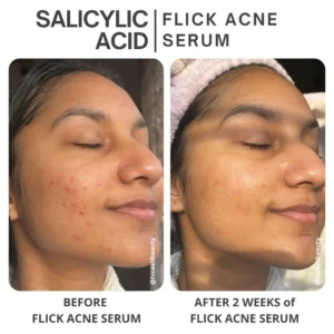 Perfect Salicylic Acid for Acne in Pakistan