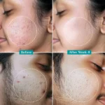 2% Salicylic Acid Anti-Acne Serum