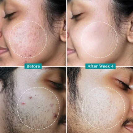 2% Salicylic Acid Anti-Acne Serum