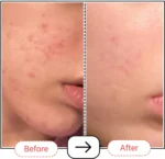 Accufix Vitamin C Serum with 10% SAP