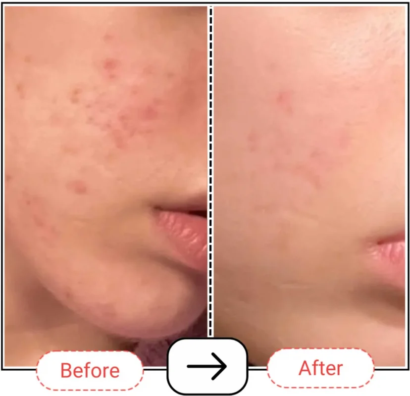 Accufix Vitamin C Serum with 10% SAP