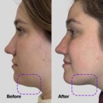 Best ShapeShift V-Line Jaw Serum