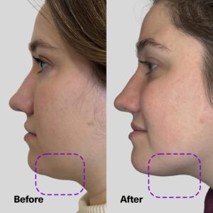 Best ShapeShift V-Line Jaw Serum